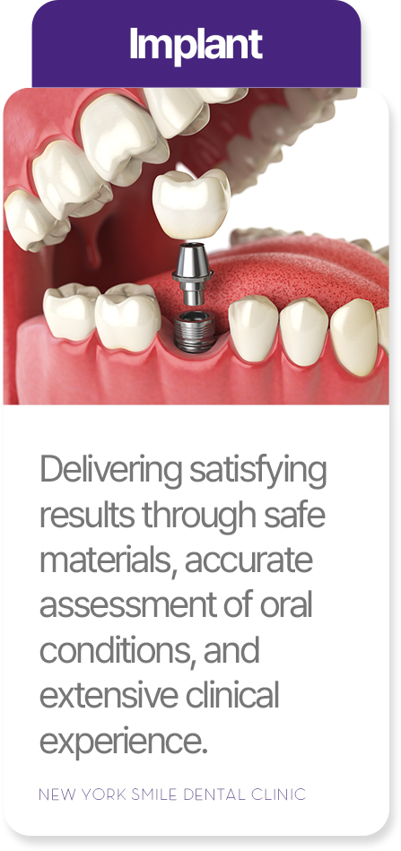 Implant treatment at New York Smile Dental Clinic
