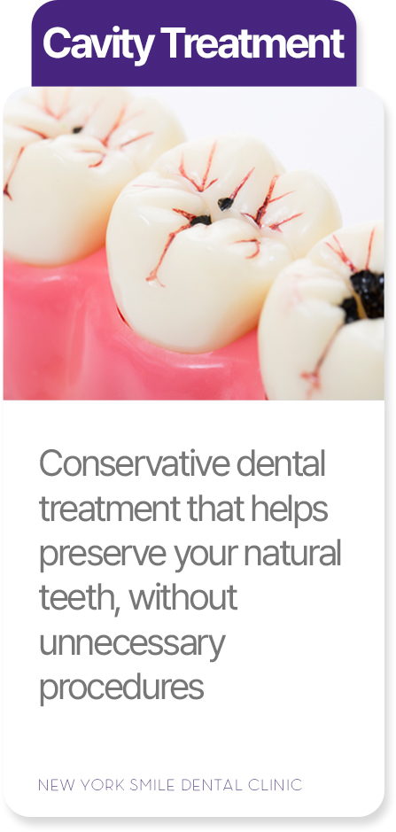 Cavity treatment at New York Smile Dental Clinic