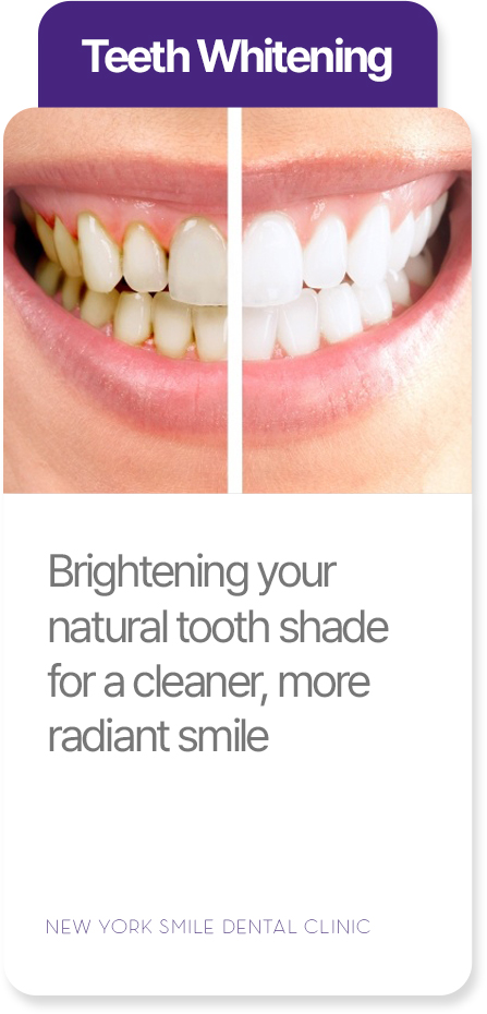 Teeth whitening at New York Smile Dental Clinic