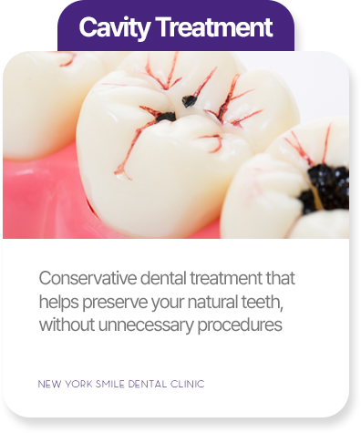 Cavity treatment at New York Smile Dental Clinic