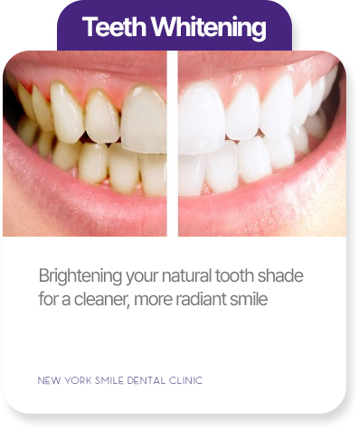 Teeth whitening at New York Smile Dental Clinic