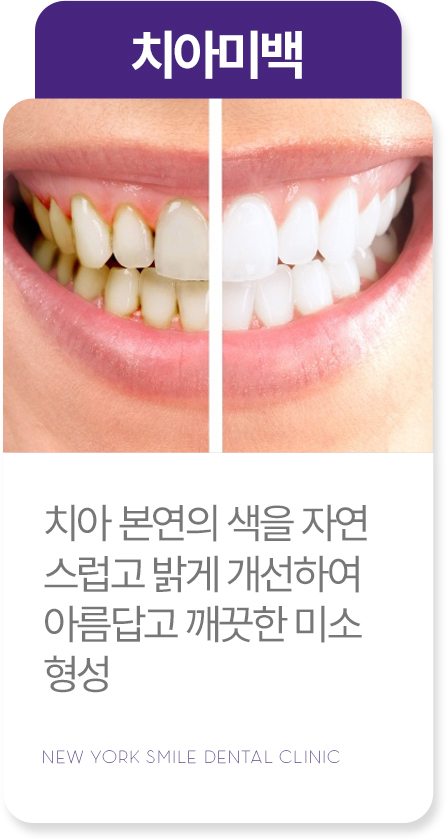 사랑니발치 사랑니발치