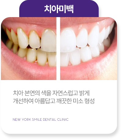 사랑니발치 사랑니발치